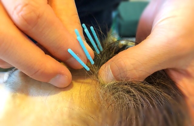 YNSA山元式新頭療法